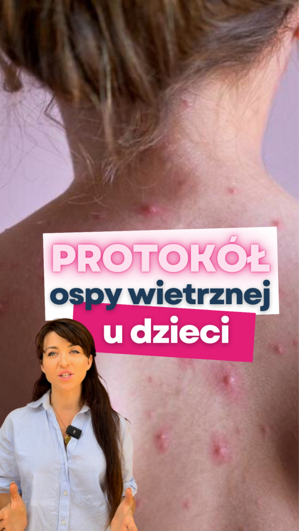protokół ospa u dzieci Ospa wietrzna jak leczyć